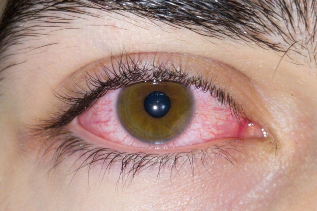 Pink Eye Infection